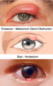 Chalazion and stye treatment