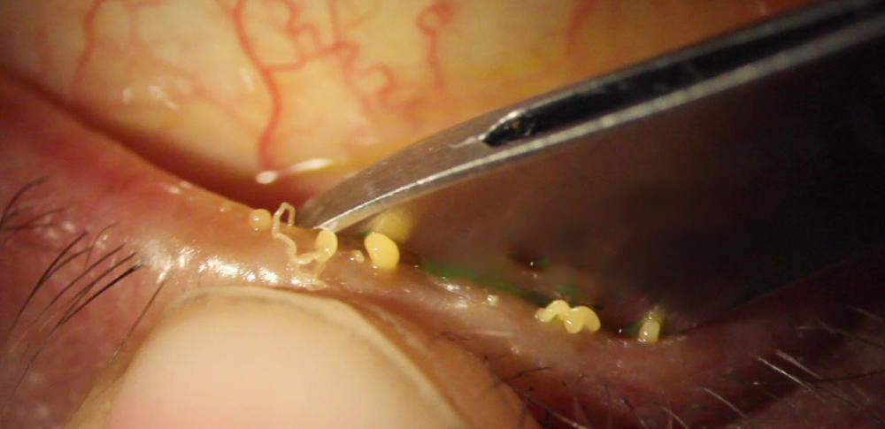 Meibomian gland expression during assessment