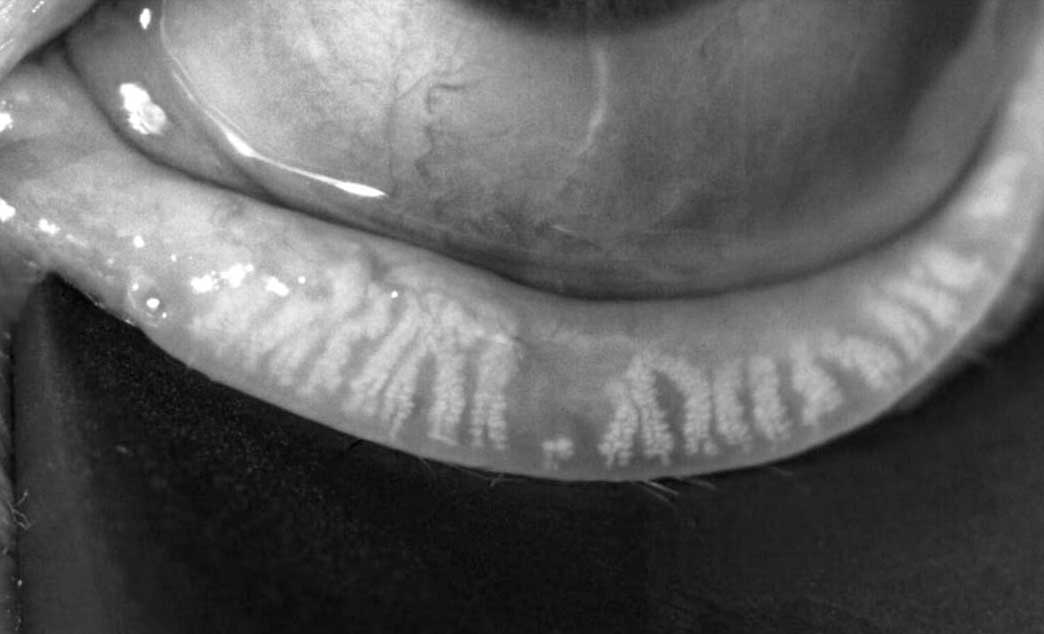 Meibomian gland scan showing tear duct structure
